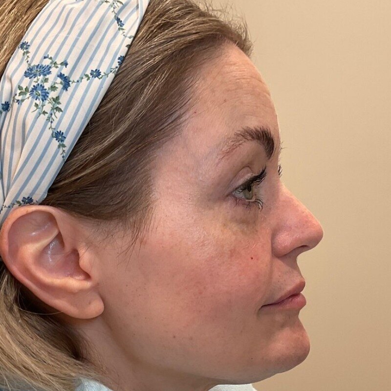 Full Facial Balancing Before & After Image