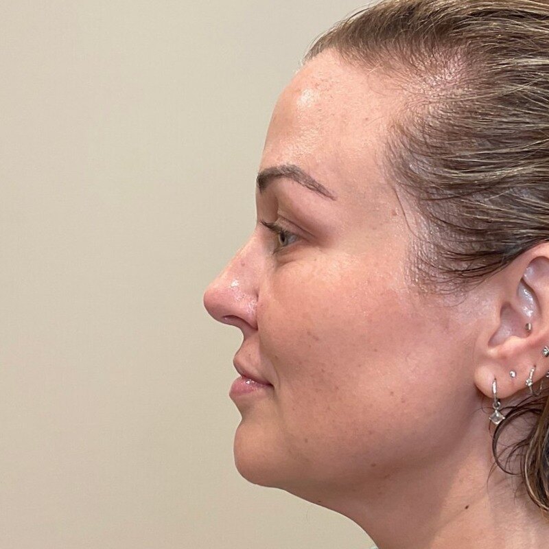 Full Facial Balancing Before & After Image