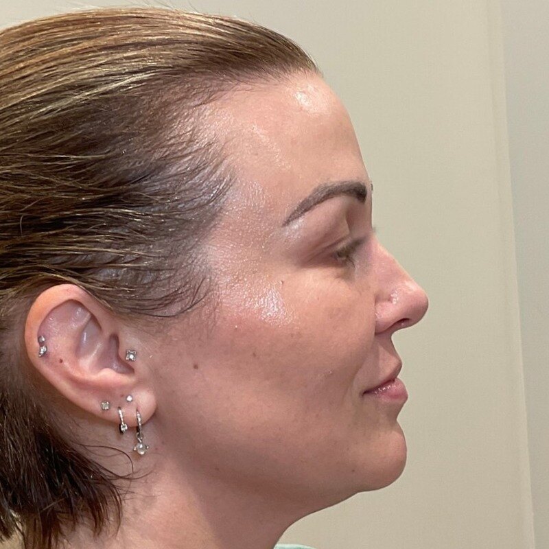 Full Facial Balancing Before & After Image