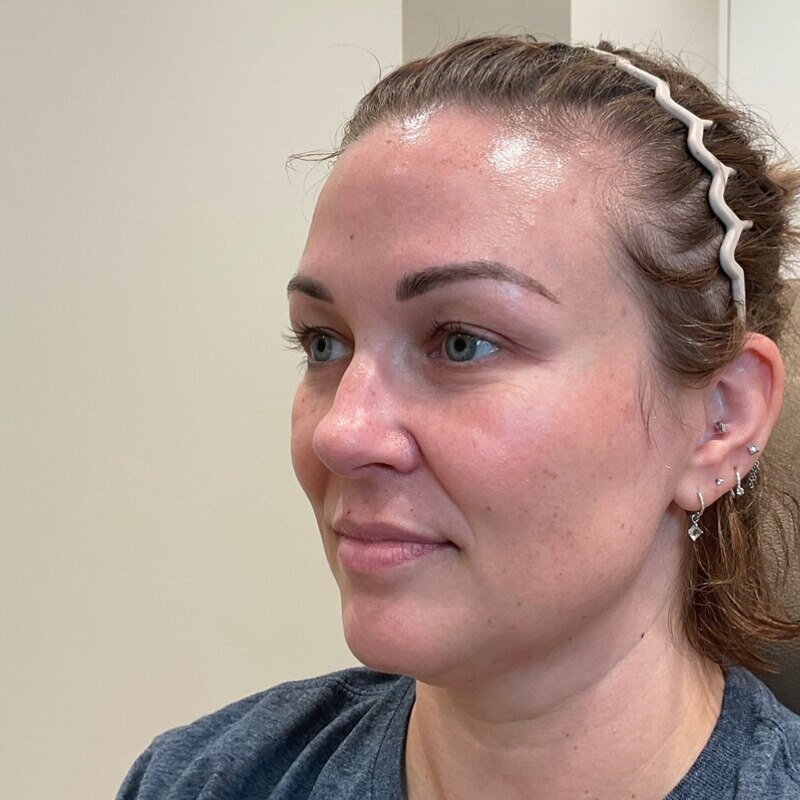 Full Facial Balancing Before & After Image