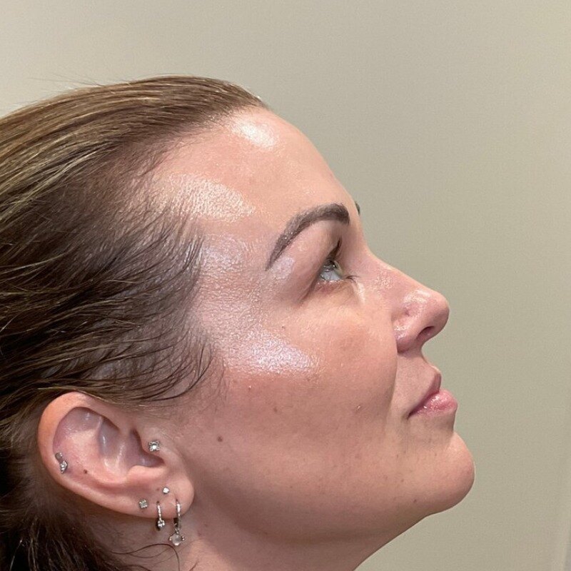Full Facial Balancing Before & After Image