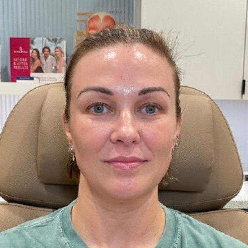 Full Facial Balancing Before & After Image