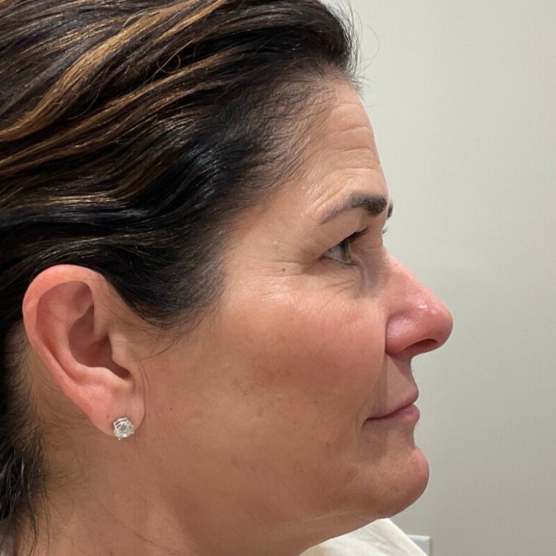 Full Facial Balancing Before & After Image
