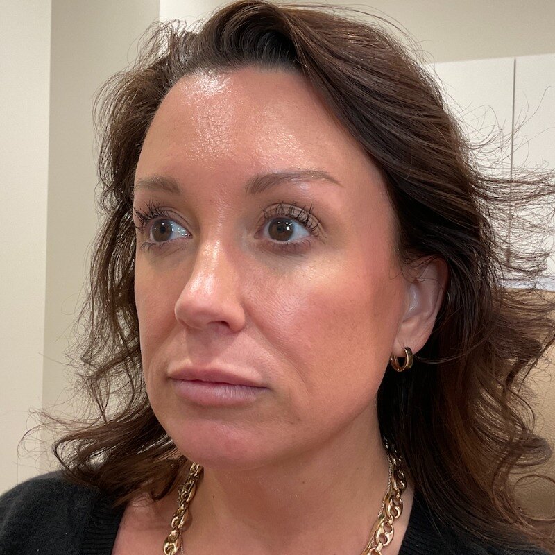 Full Facial Balancing Before & After Image