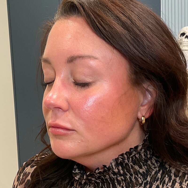 Full Facial Balancing Before & After Image