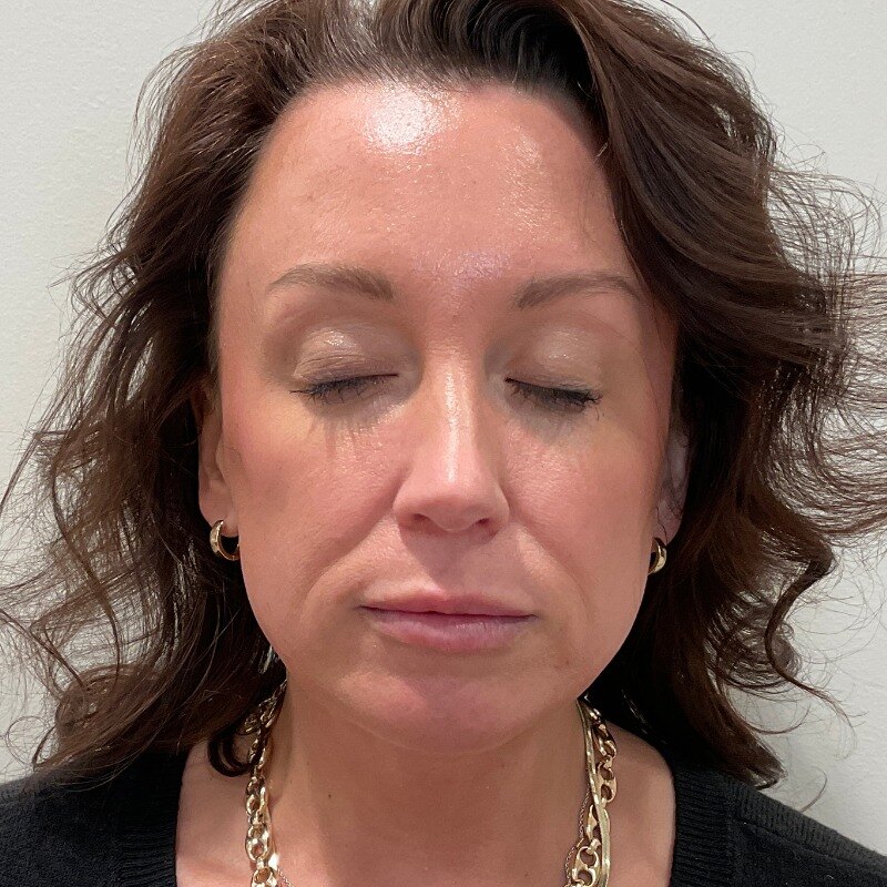 Full Facial Balancing Before & After Image