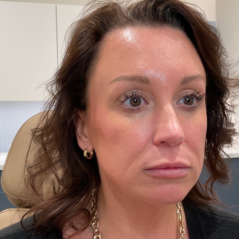 Full Facial Balancing Before & After Image