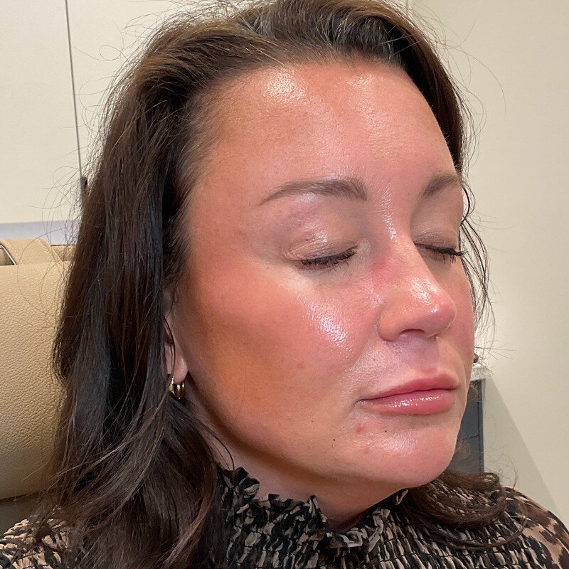 Full Facial Balancing Before & After Image