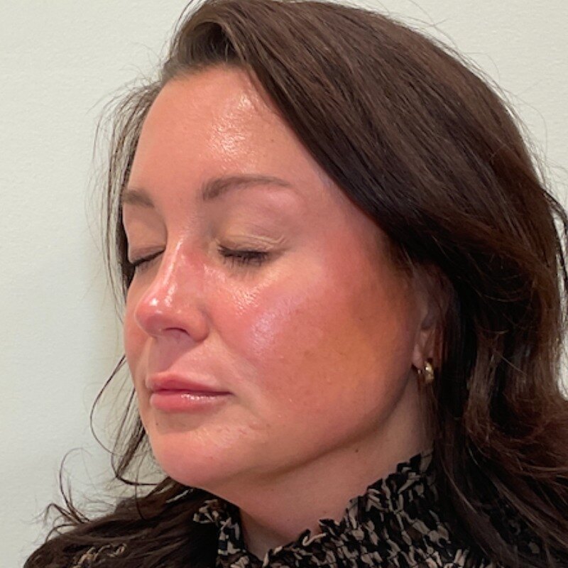Full Facial Balancing Before & After Image