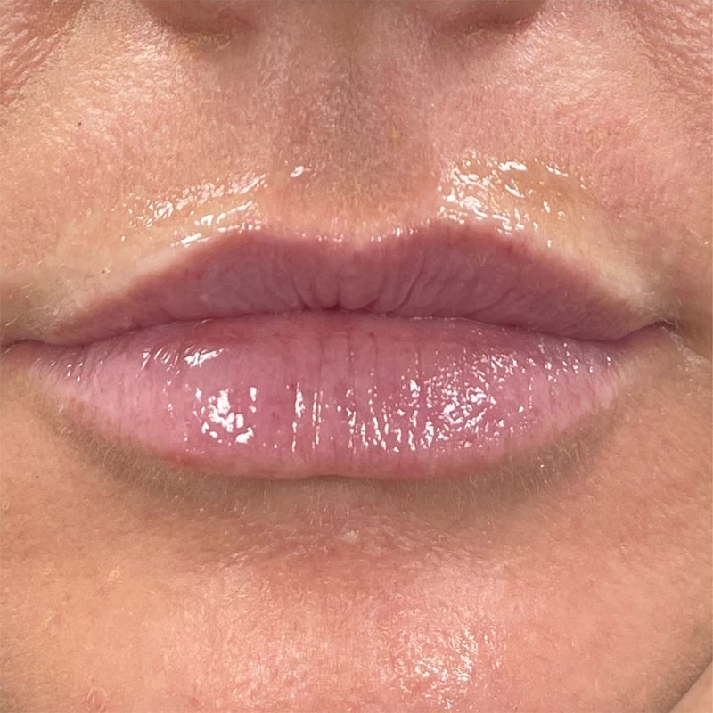 Lip Fillers Before & After Image