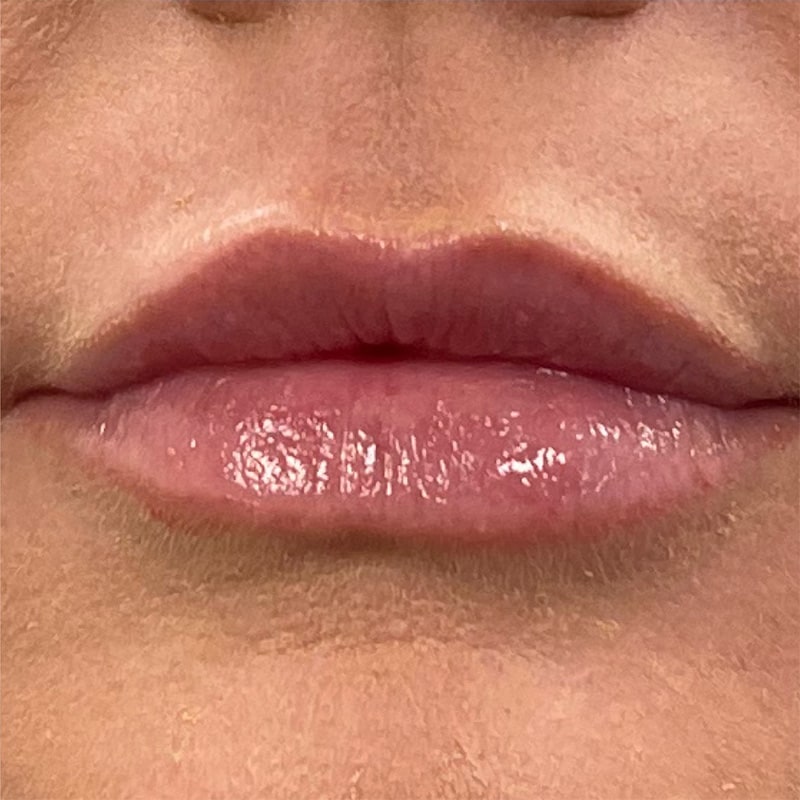 Lip Fillers Before & After Image
