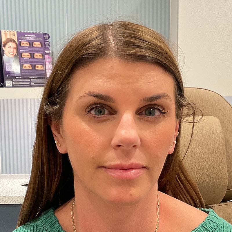 Lip Fillers Before & After Image