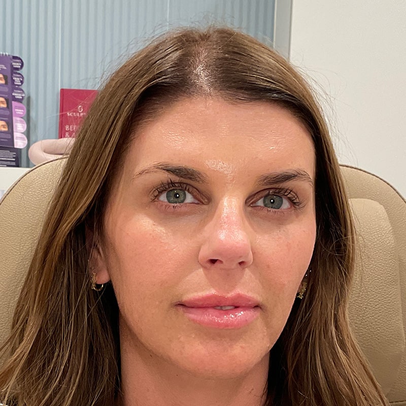 Lip Fillers Before & After Image