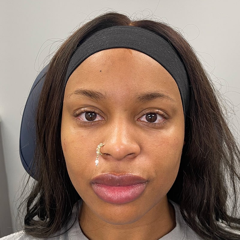 Lip Fillers Before & After Image