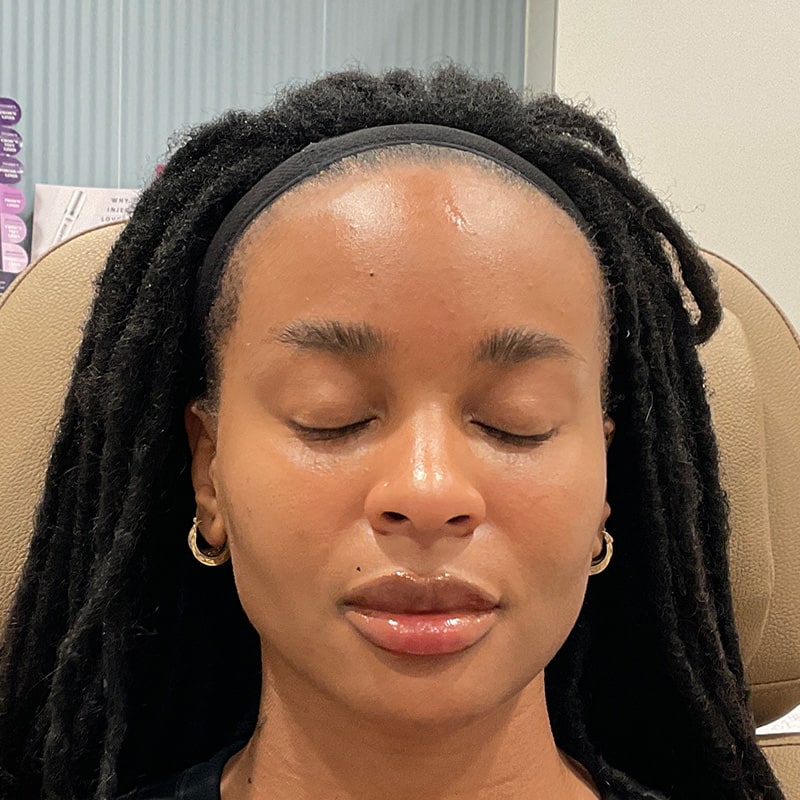 Lip Fillers Before & After Image