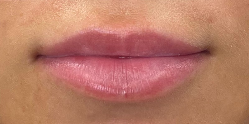Lip Fillers Before & After Image