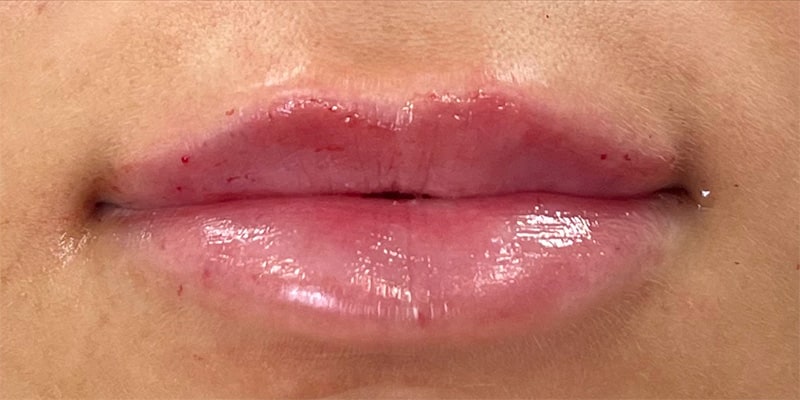 Lip Fillers Before & After Image