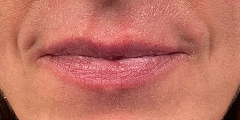 Lip Fillers Before & After Image