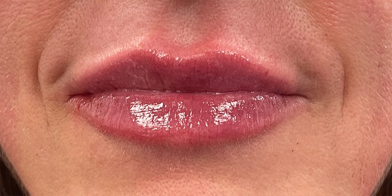 Lip Fillers Before & After Image