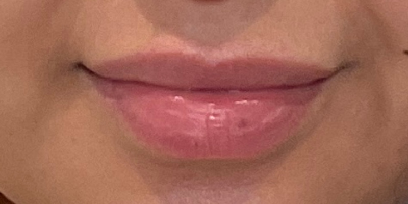 lip fillers Before & After Image