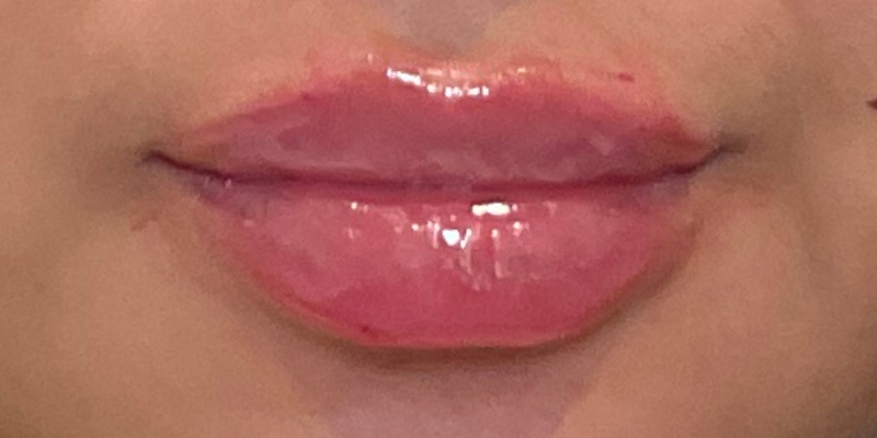 lip fillers Before & After Image