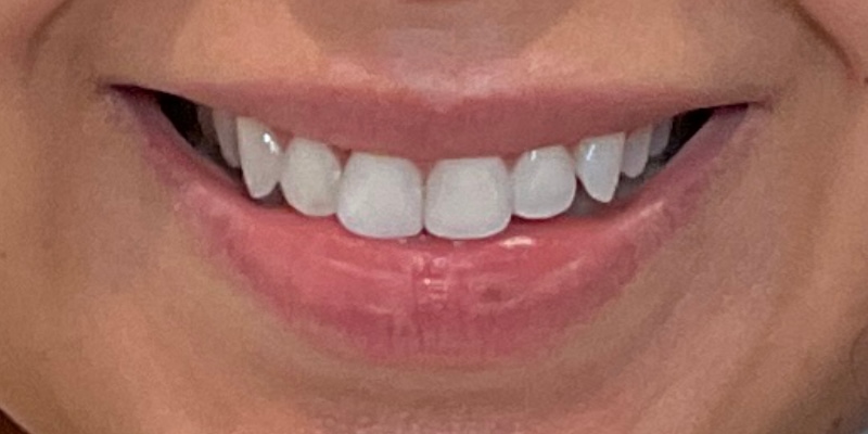 lip fillers Before & After Image