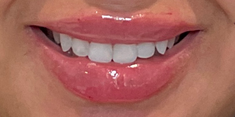lip fillers Before & After Image