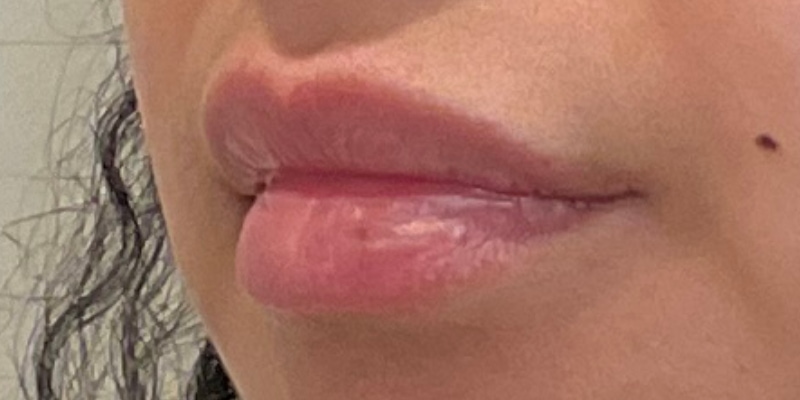 lip fillers Before & After Image