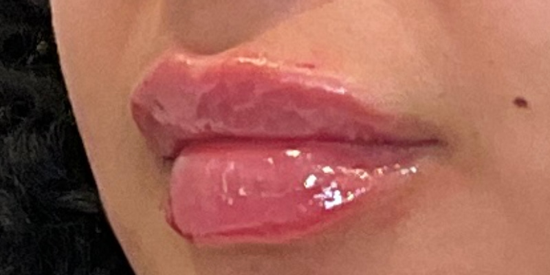 lip fillers Before & After Image