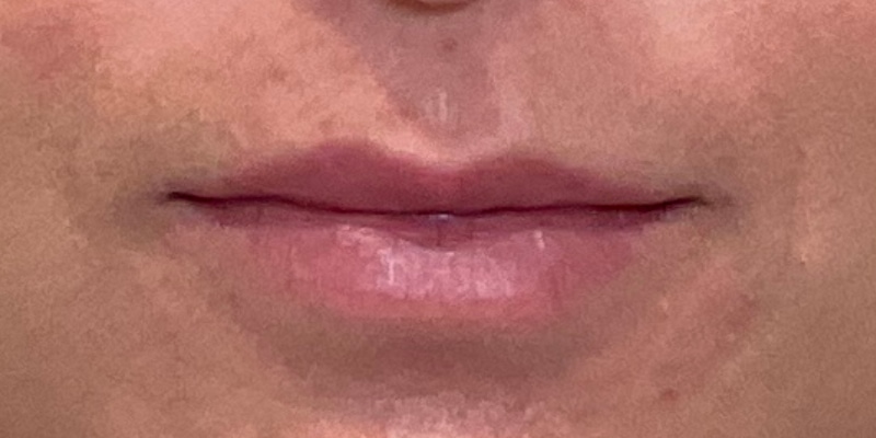 lip fillers Before & After Image