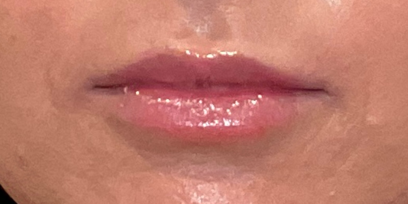 lip fillers Before & After Image