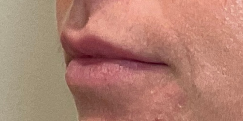 lip fillers Before & After Image