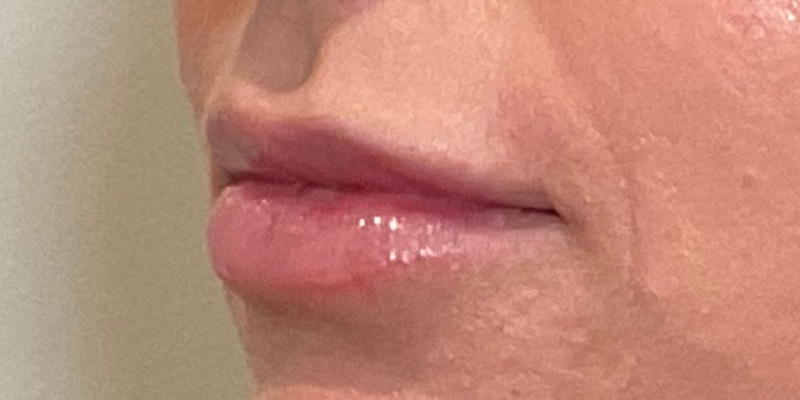 lip fillers Before & After Image