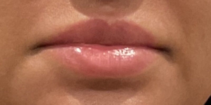 lip fillers Before & After Image