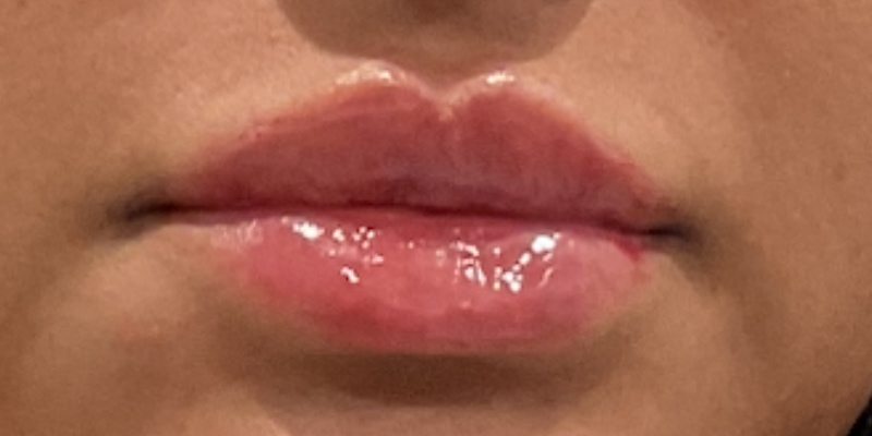 lip fillers Before & After Image