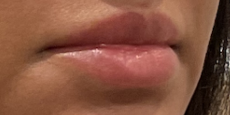lip fillers Before & After Image
