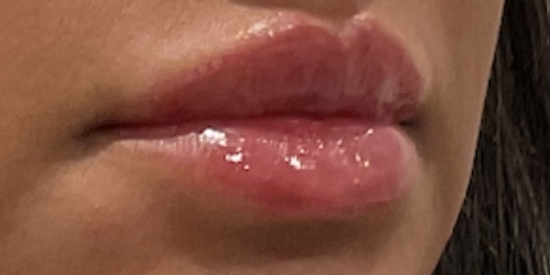 lip fillers Before & After Image