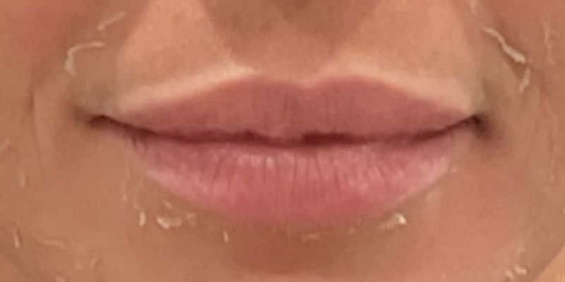 lip fillers Before & After Image