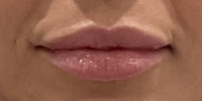 lip fillers Before & After Image