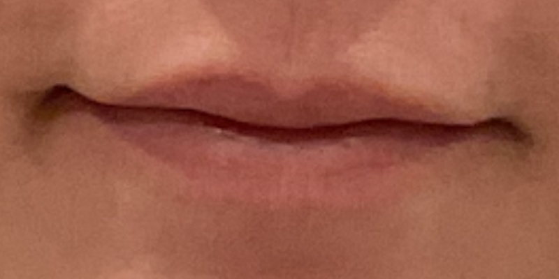 lip fillers Before & After Image