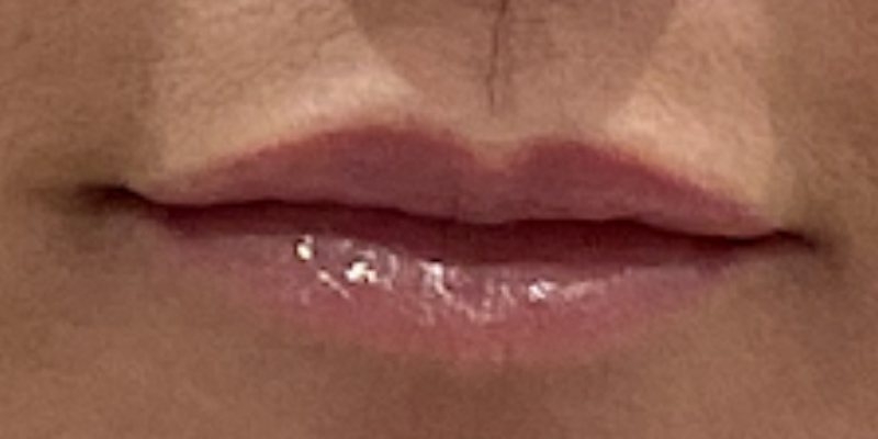 lip fillers Before & After Image