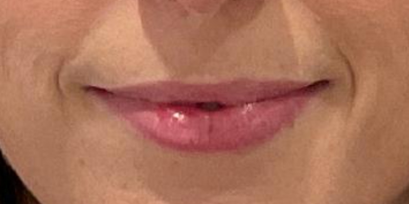 lip fillers Before & After Image