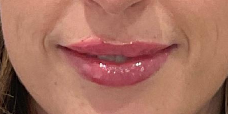 lip fillers Before & After Image