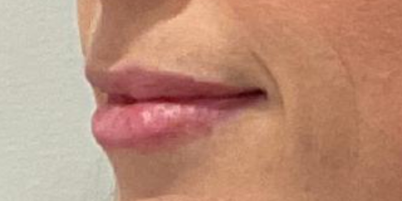 lip fillers Before & After Image