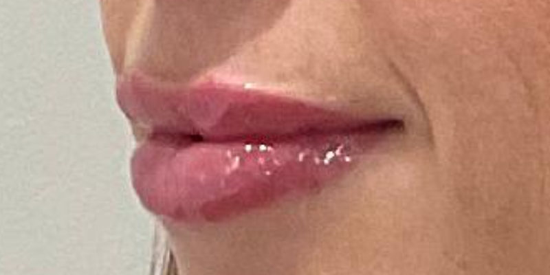 lip fillers Before & After Image