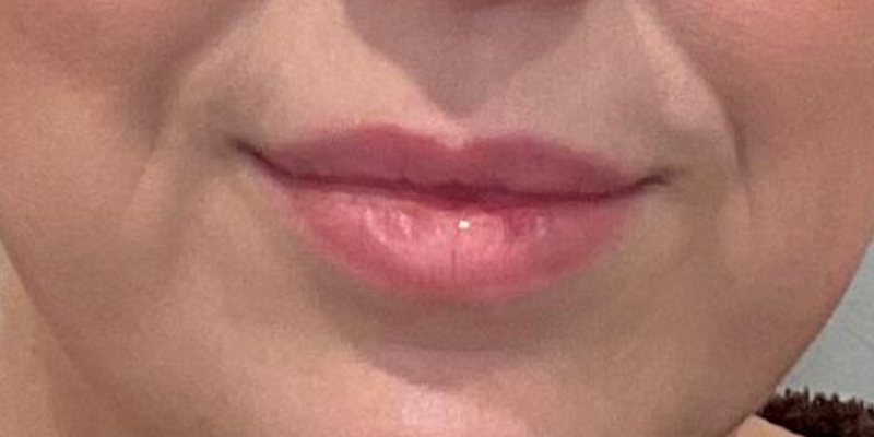 lip fillers Before & After Image