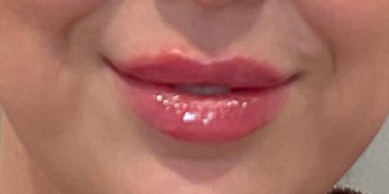 lip fillers Before & After Image