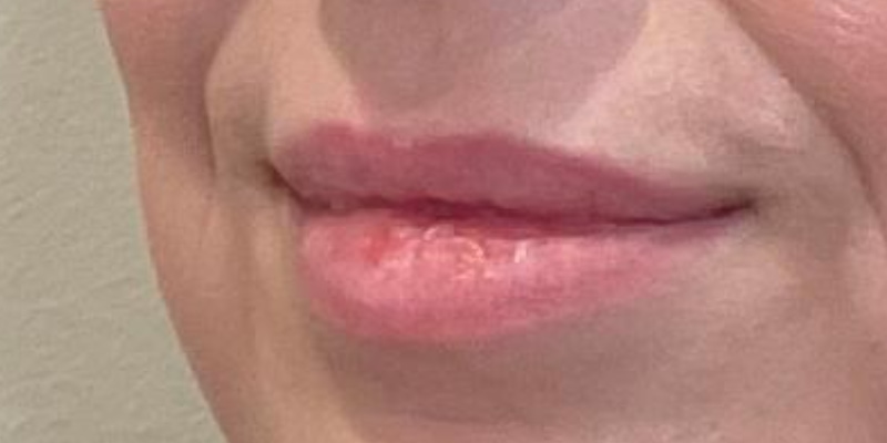 lip fillers Before & After Image