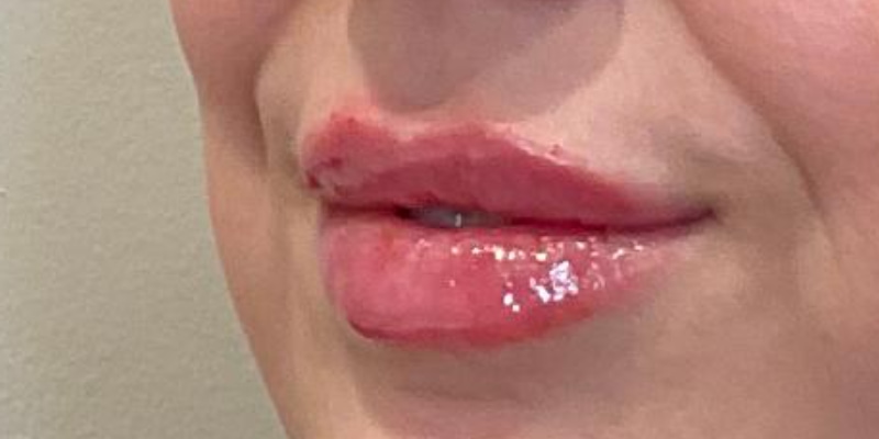 lip fillers Before & After Image
