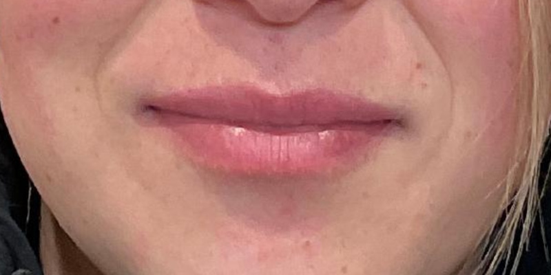 Lip Fillers Before & After Image